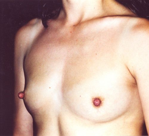 Breast Augmentation Before & After