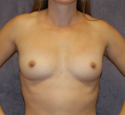 Breast Augmentation Before & After