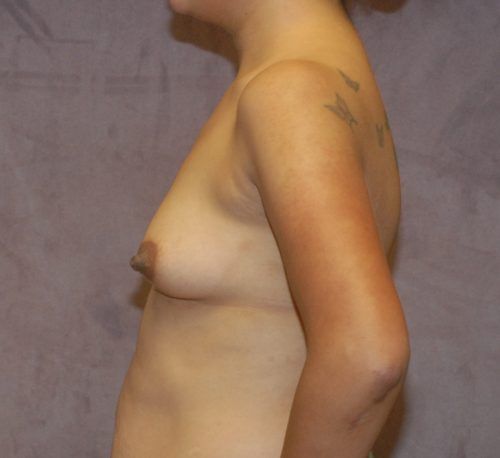 Breast Augmentation Before & After