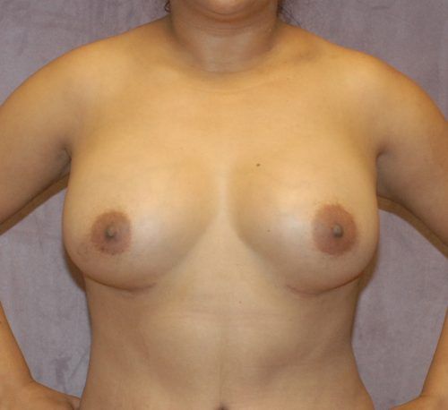 Breast Augmentation Before & After