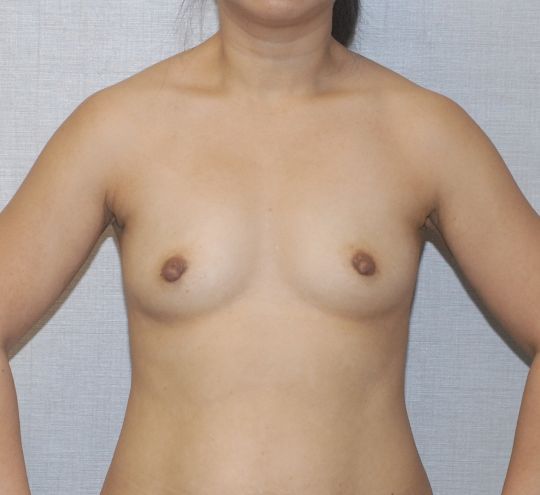 Breast Augmentation Before & After