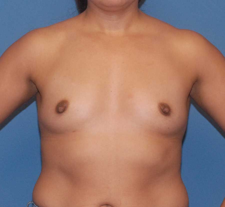Breast Augmentation Before & After