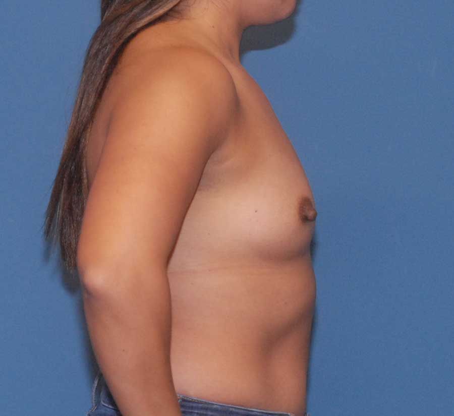 Breast Augmentation Before & After