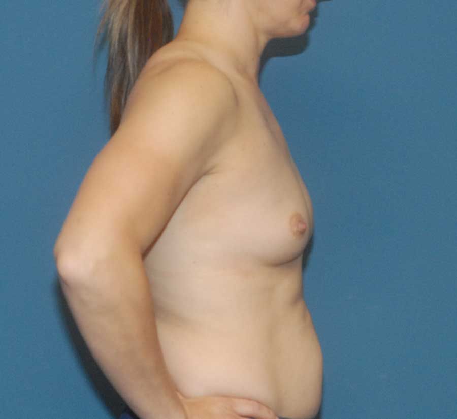 Breast Augmentation Before & After