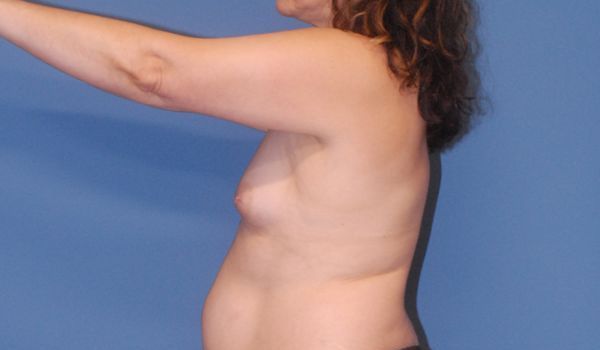 Breast Augmentation Before & After