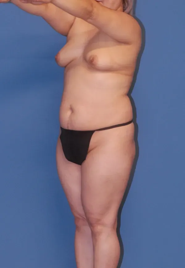 Fat Grafting To Breast Before & After