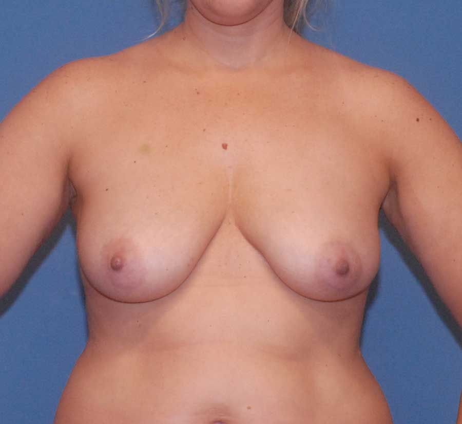 Fat Grafting To Breast Before & After