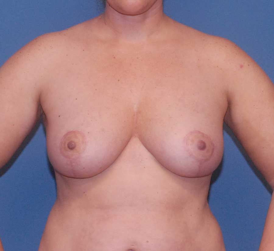 Fat Grafting To Breast Before & After