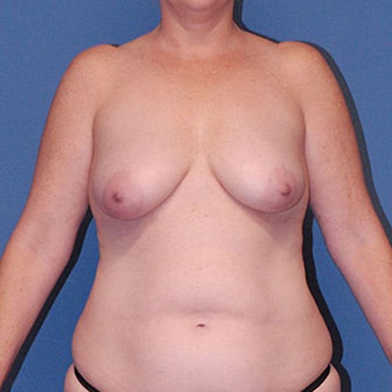 Fat Grafting To Breast Before & After