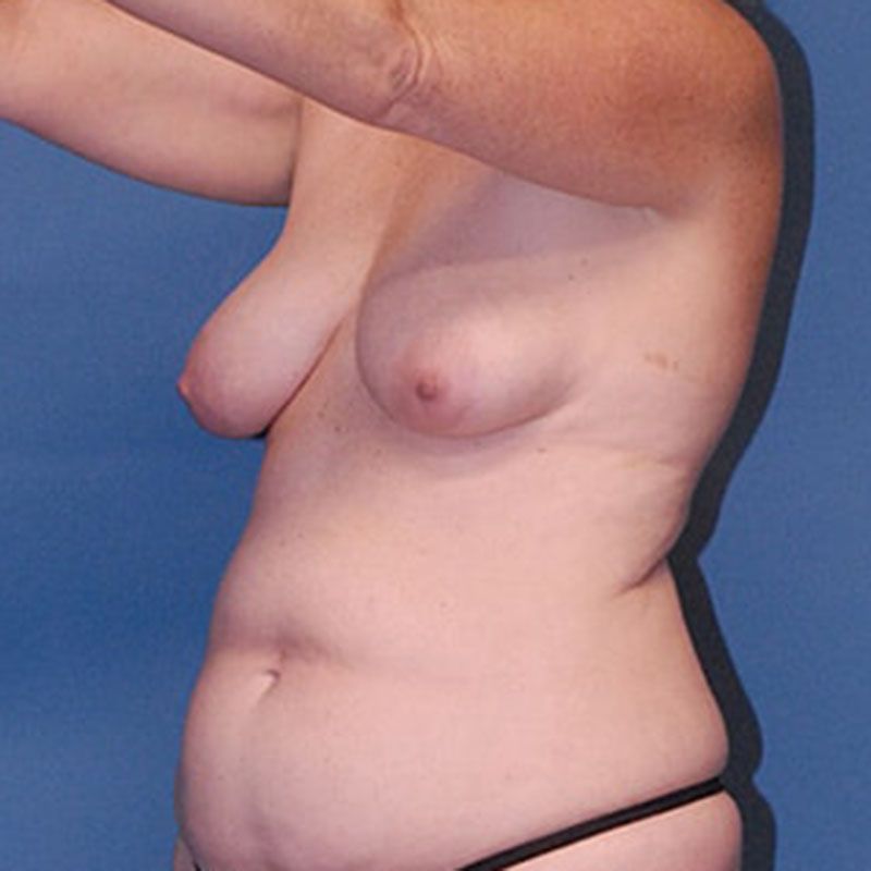Fat Grafting To Breast Before & After