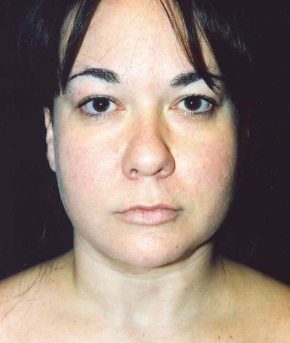 Liposuction Face Before & After