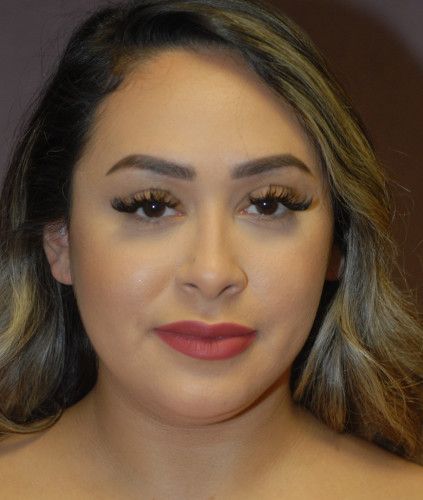 Liposuction Face Before & After