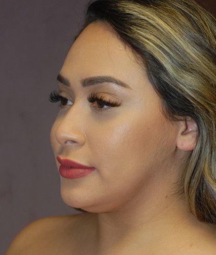 Liposuction Face Before & After