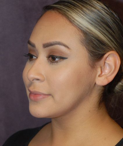 Liposuction Face Before & After