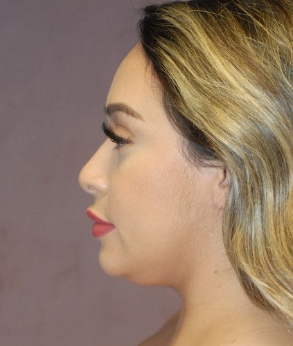 Liposuction Face Before & After