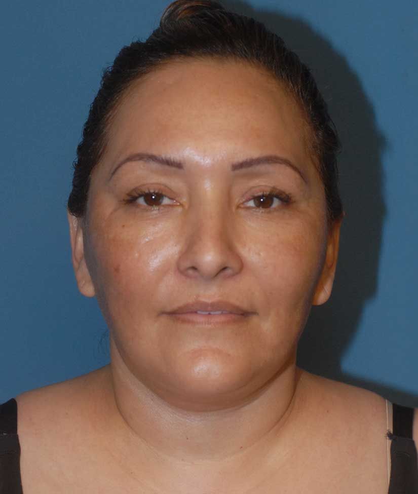 Liposuction Face Before & After