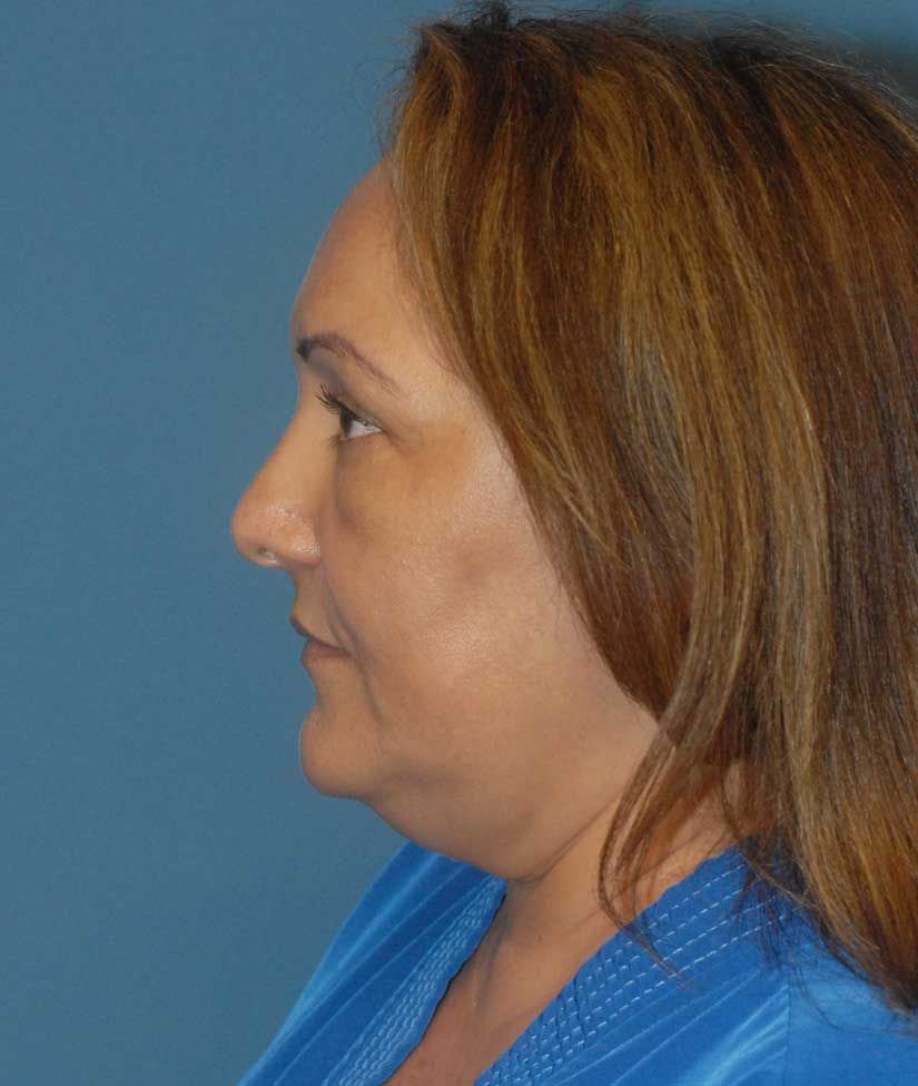 Liposuction Face Before & After