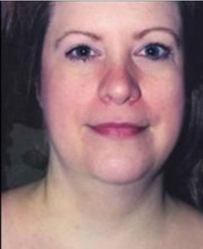 Liposuction Face Before & After