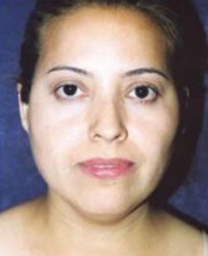 Liposuction Face Before & After