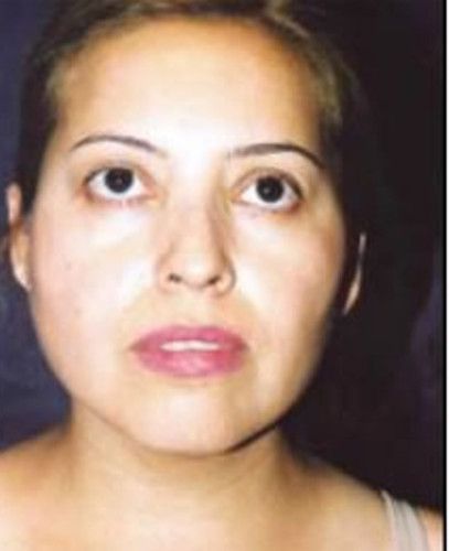 Liposuction Face Before & After