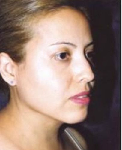 Liposuction Face Before & After