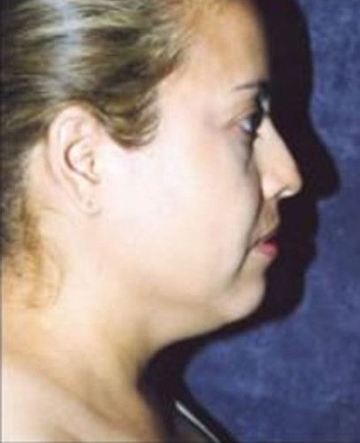 Liposuction Face Before & After