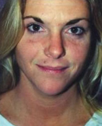 Liposuction Face Before & After