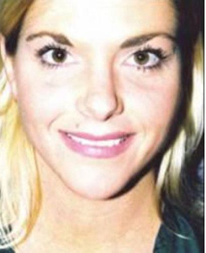 Liposuction Face Before & After