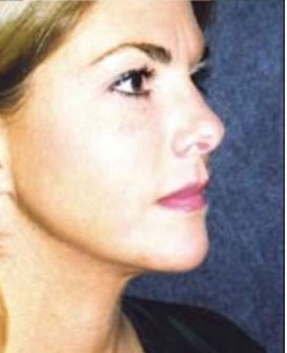 Liposuction Face Before & After