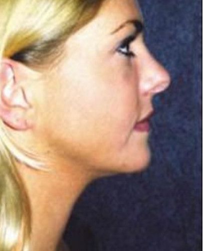 Liposuction Face Before & After