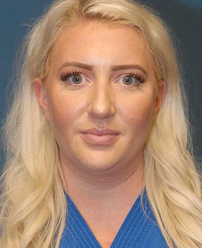 Liposuction Face Before & After