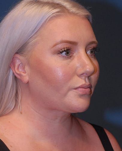 Liposuction Face Before & After