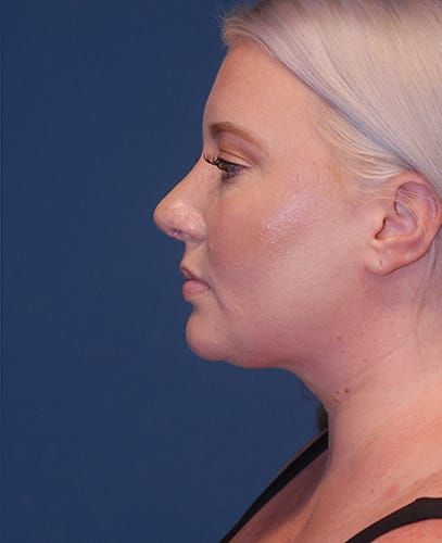 Liposuction Face Before & After