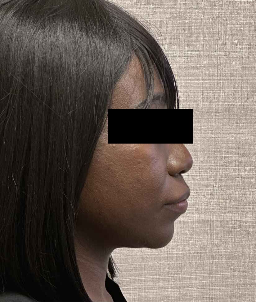 Liposuction Face Before & After