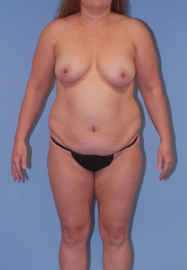 Fortes Figure Before & After