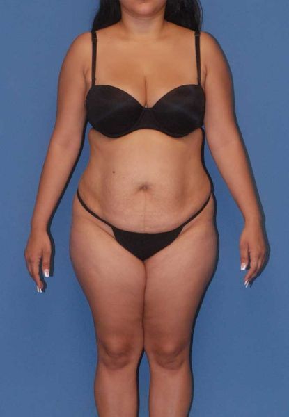 Fortes Figure Before & After