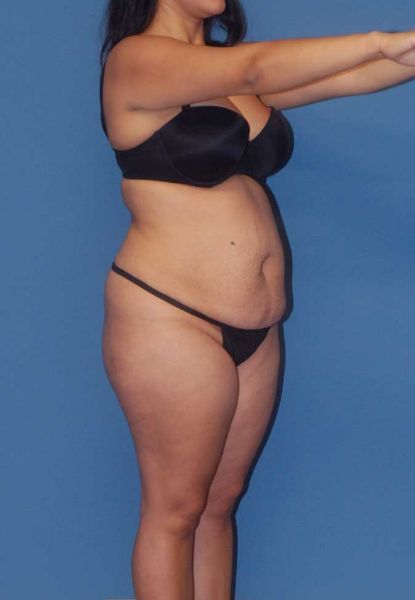 Fortes Figure Before & After