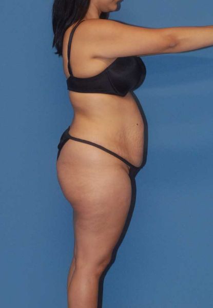 Fortes Figure Before & After