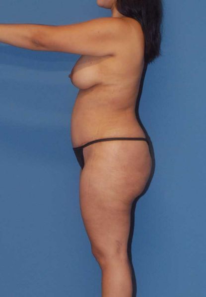 Fortes Figure Before & After