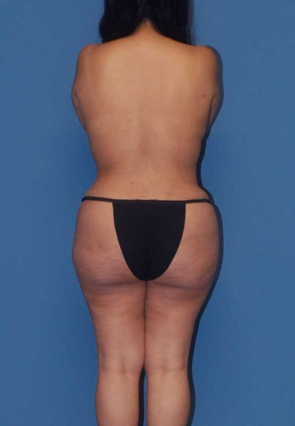 Fortes Figure Before & After