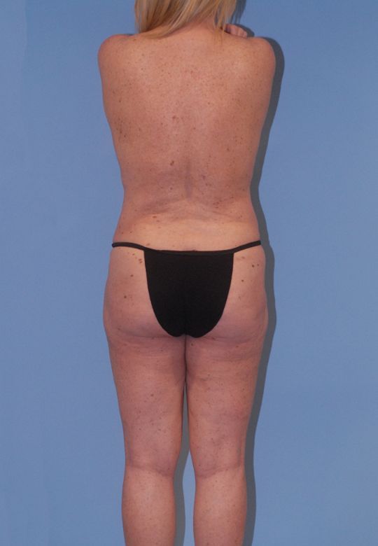 Fortes Figure Before & After