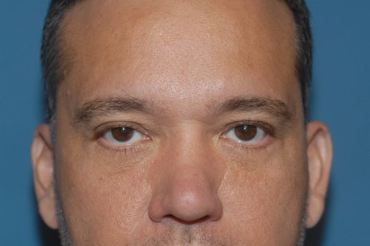 Blepharoplasty Before & After