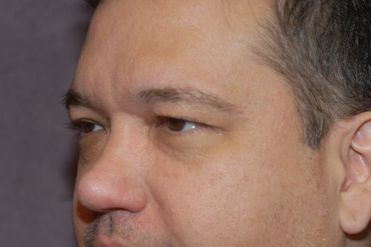 Blepharoplasty Before & After