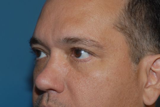 Blepharoplasty Before & After