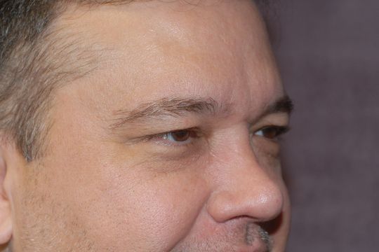 Blepharoplasty Before & After