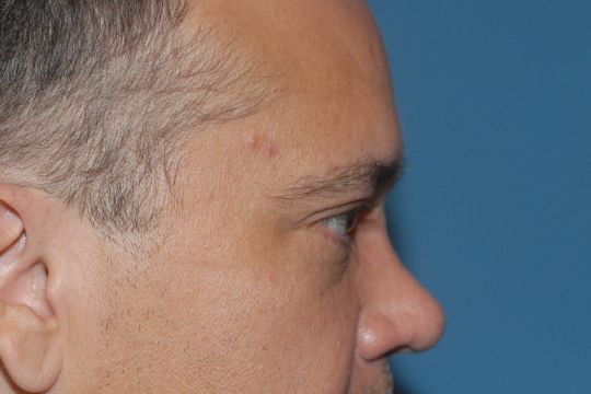 Blepharoplasty Before & After