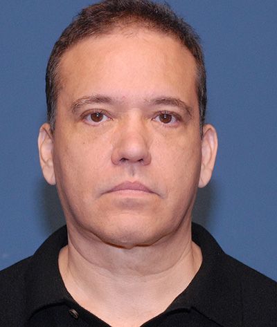 Blepharoplasty Before & After