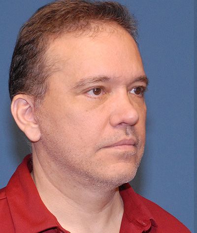 Blepharoplasty Before & After