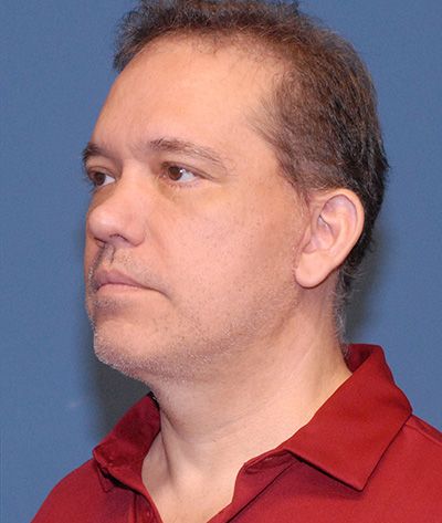 Blepharoplasty Before & After