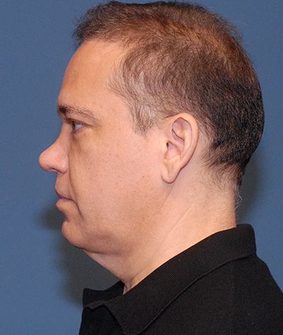 Blepharoplasty Before & After